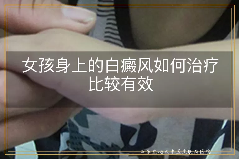 女孩身上的白癜风如何治疗比较有效