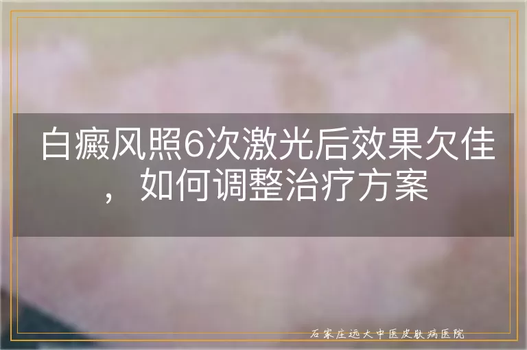 白癜风照6次激光后效果欠佳,如何调整治疗方案
