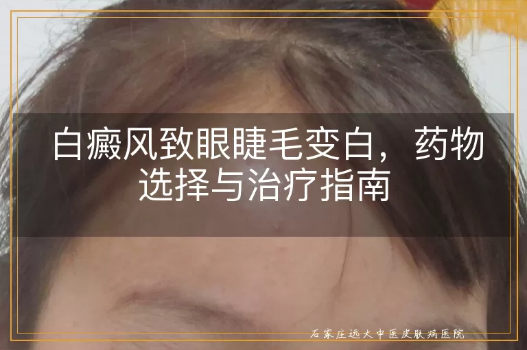 白癜风致眼睫毛变白，药物选择与治疗指南