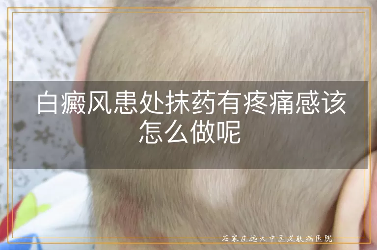 白癜风患处抹药有疼痛感该怎么做呢