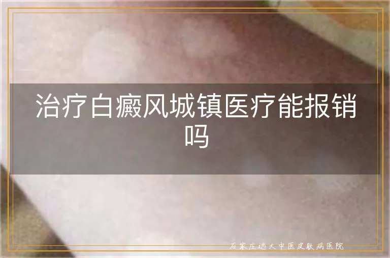 治疗白癜风城镇医疗能报销吗