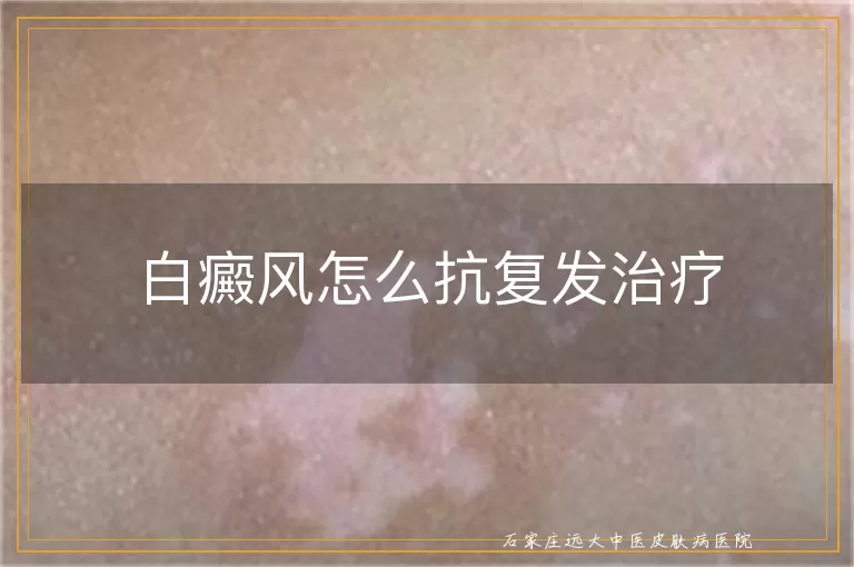 白癜风怎么抗复发治疗