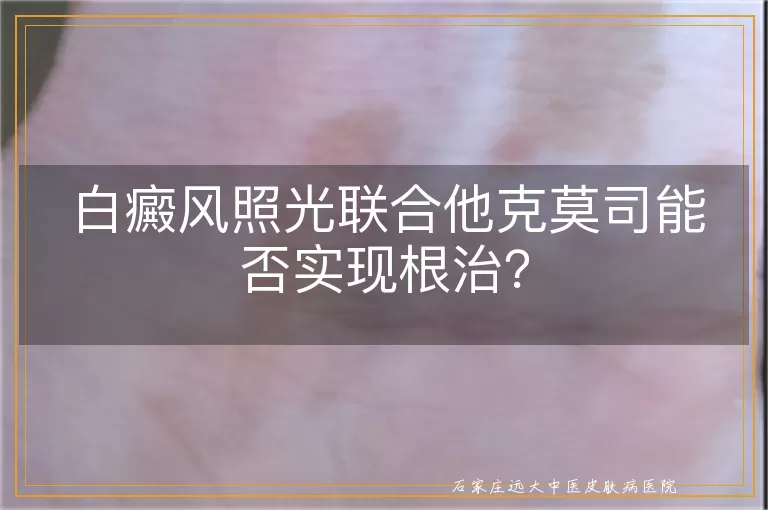 白癜风照光联合他克莫司能否实现根治？