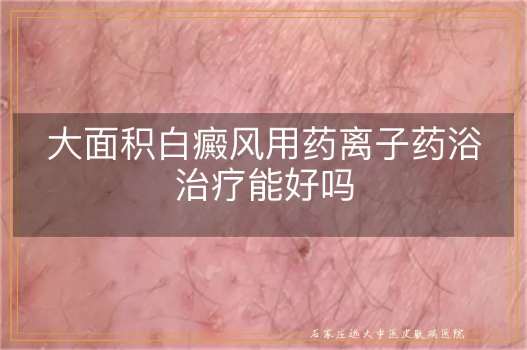 大面积白癜风用药离子药浴治疗能好吗