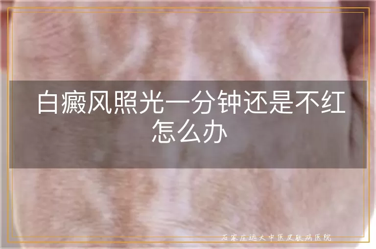 白癜风照光一分钟还是不红怎么办