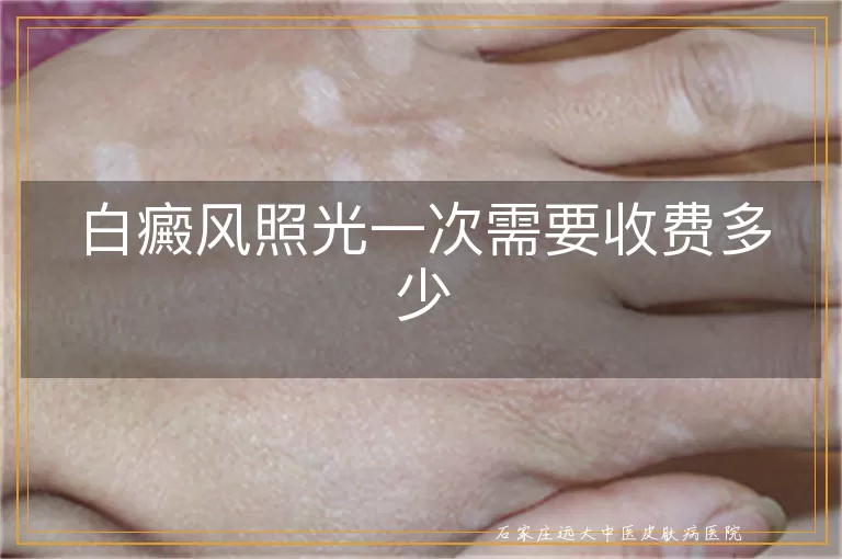白癜风照光一次需要收费多少