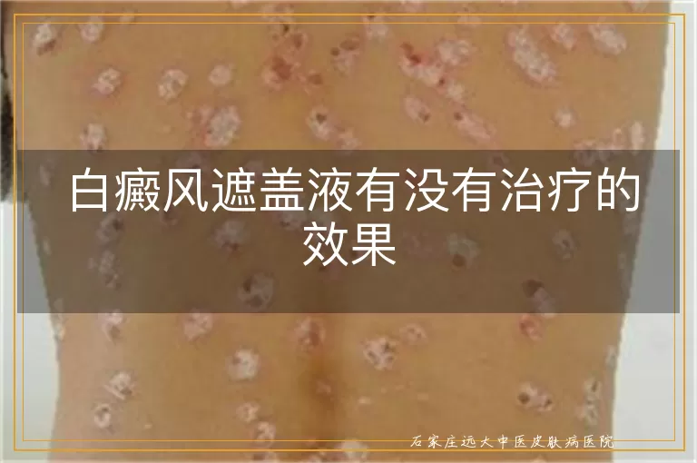 白癜风遮盖液有没有治疗的效果