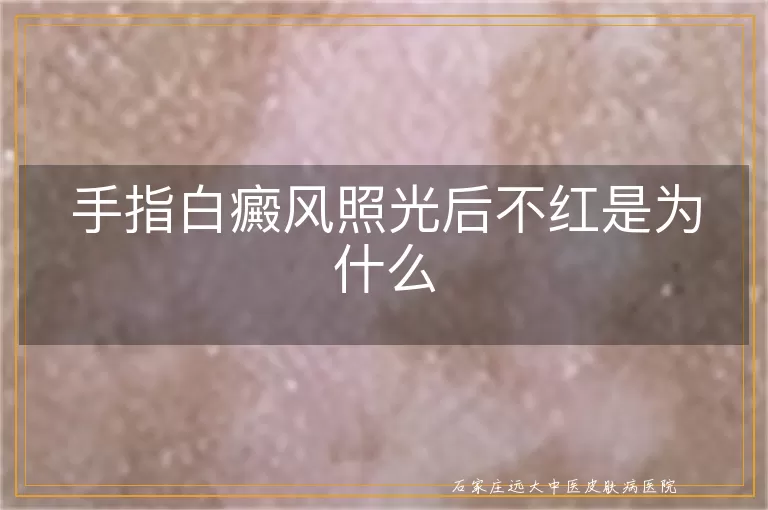 手指白癜风照光后不红是为什么