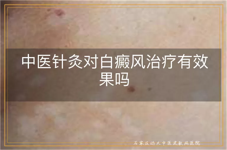 中医针灸对白癜风治疗有效果吗