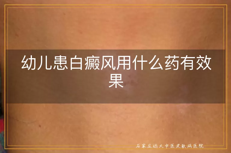 幼儿患白癜风用什么药有效果