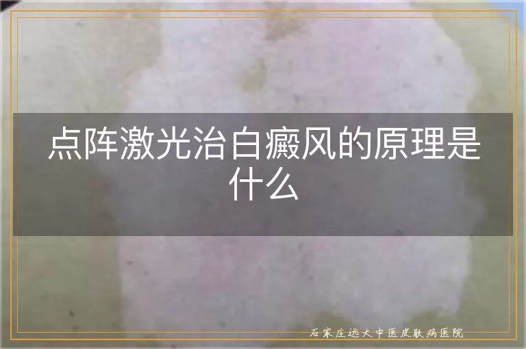 点阵激光治白癜风的原理是什么
