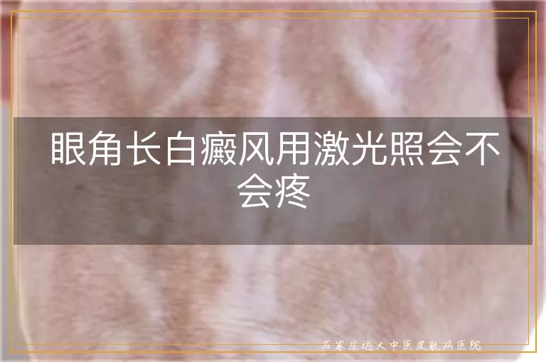 眼角长白癜风用激光照会不会疼