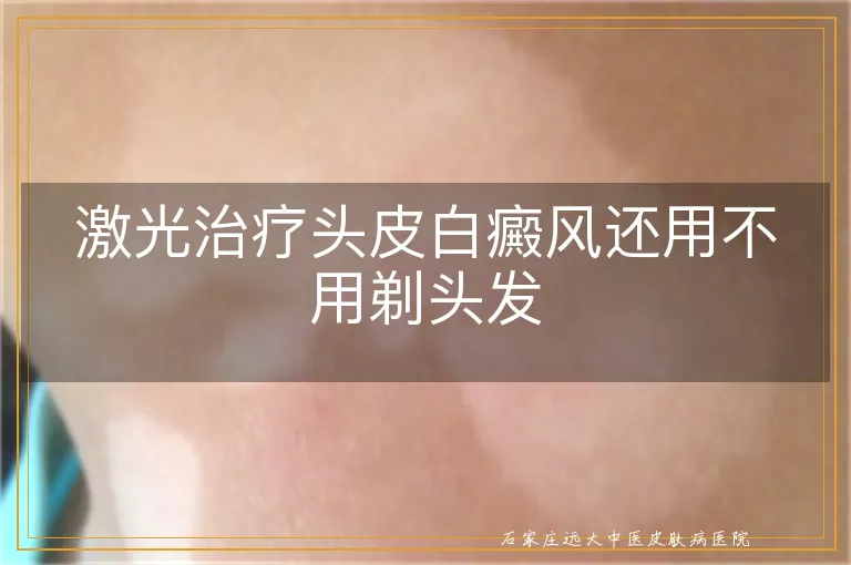 激光治疗头皮白癜风还用不用剃头发