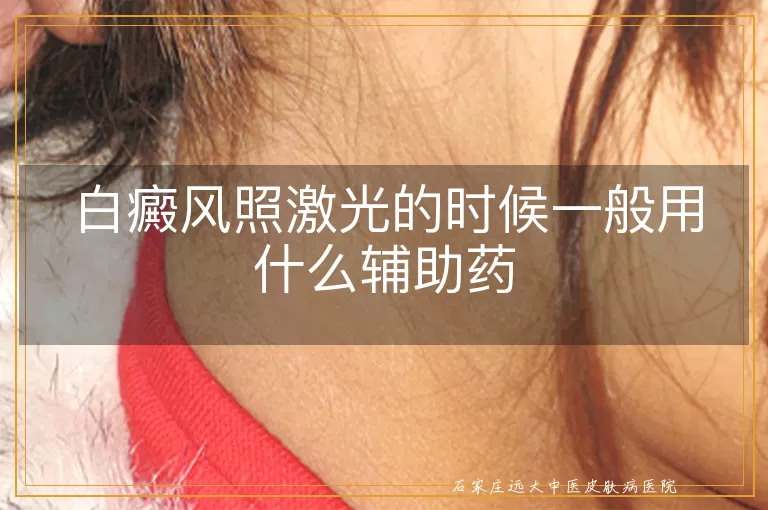 白癜风照激光的时候一般用什么辅助药