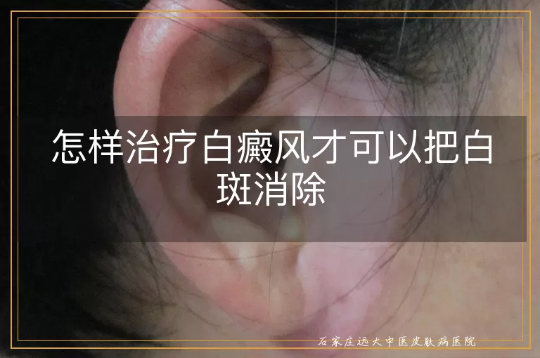 怎样治疗白癜风才可以把白斑消除