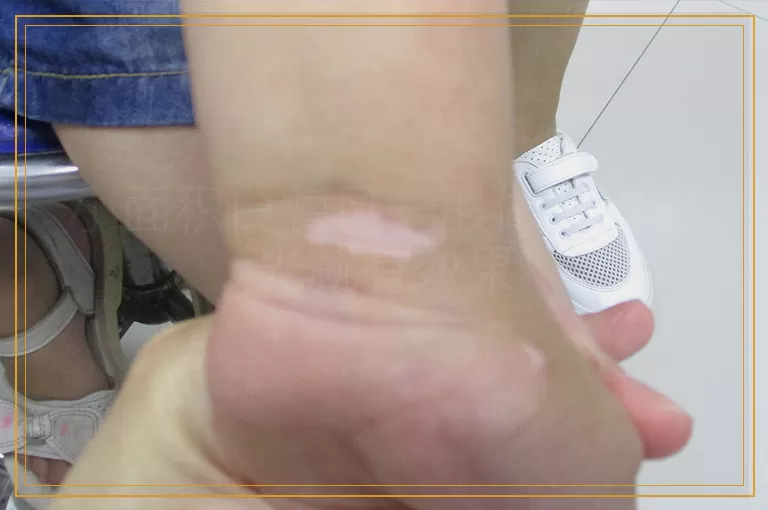 小面积白癜风一般做几次激光就有效果