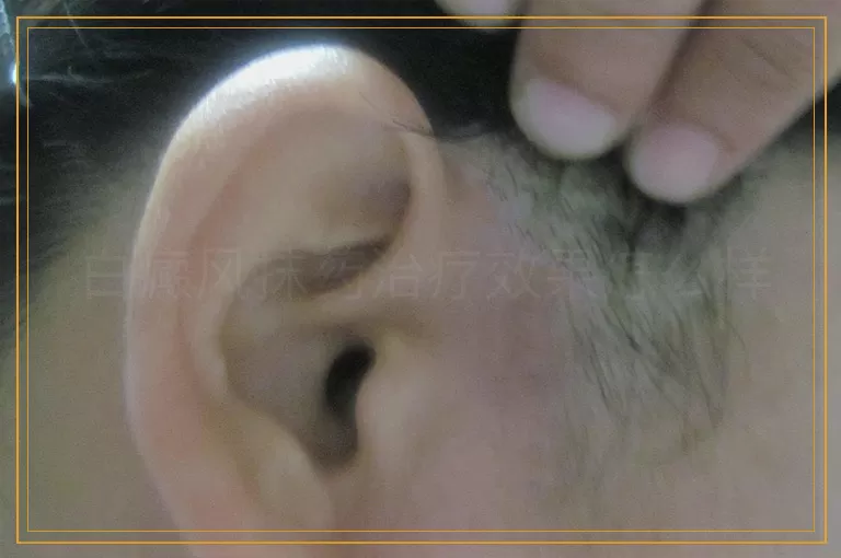 白癜风抹药治疗效果怎么样