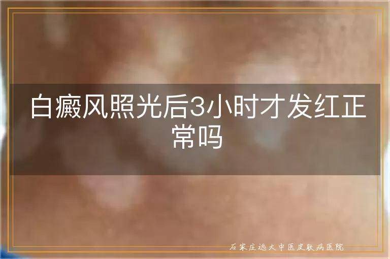 白癜风照光后3小时才发红正常吗