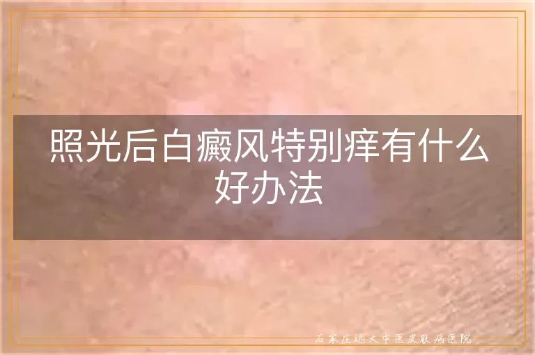 照光后白癜风特别痒有什么好办法