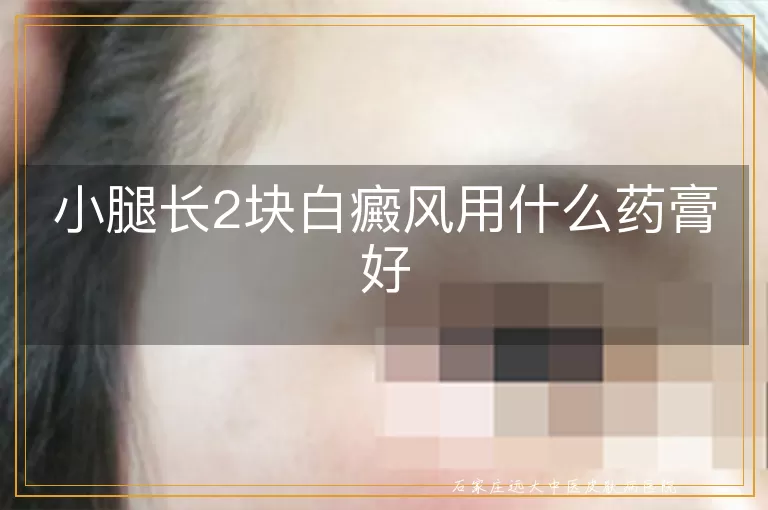 小腿长2块白癜风用什么药膏好