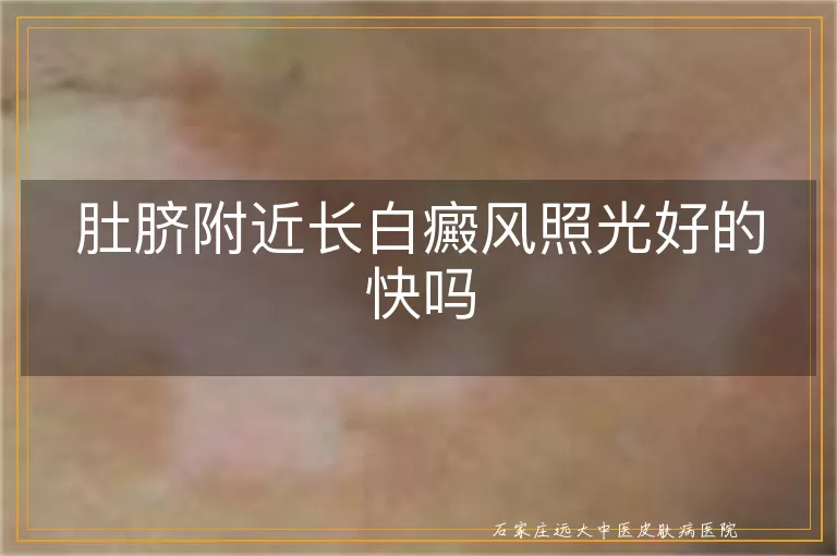 肚脐附近长白癜风照光好的快吗