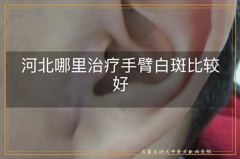 河北哪里治疗手臂白斑比较好