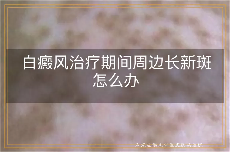白癜风治疗期间周边长新斑怎么办