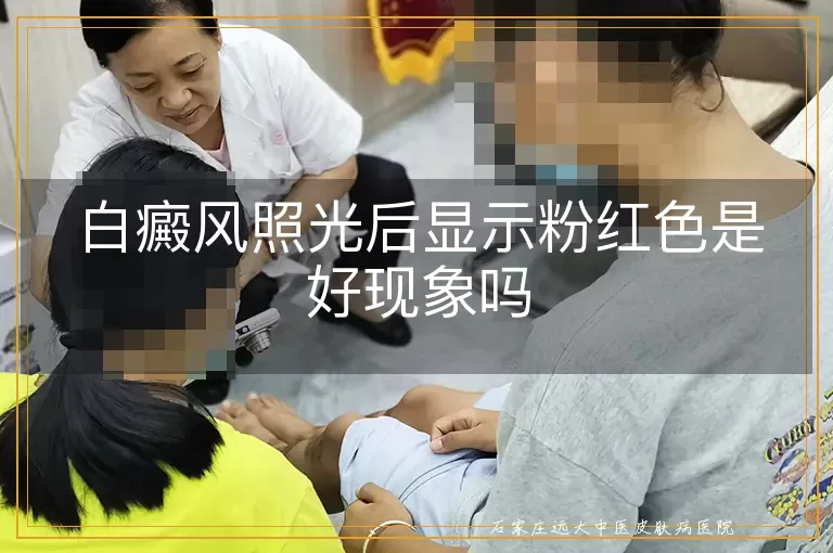 白癜风照光后显示粉红色是好现象吗