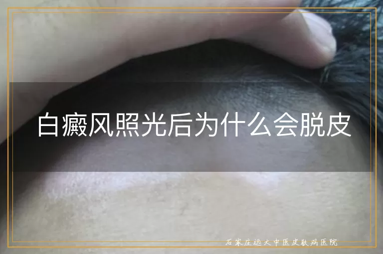 白癜风照光后为什么会脱皮