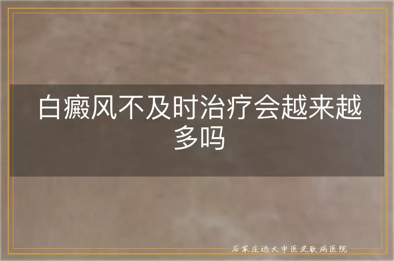 白癜风不及时治疗会越来越多吗