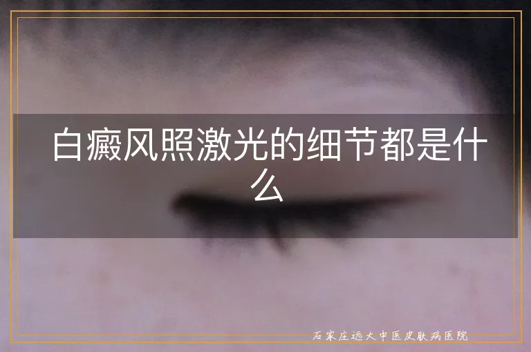 白癜风照激光的细节都是什么