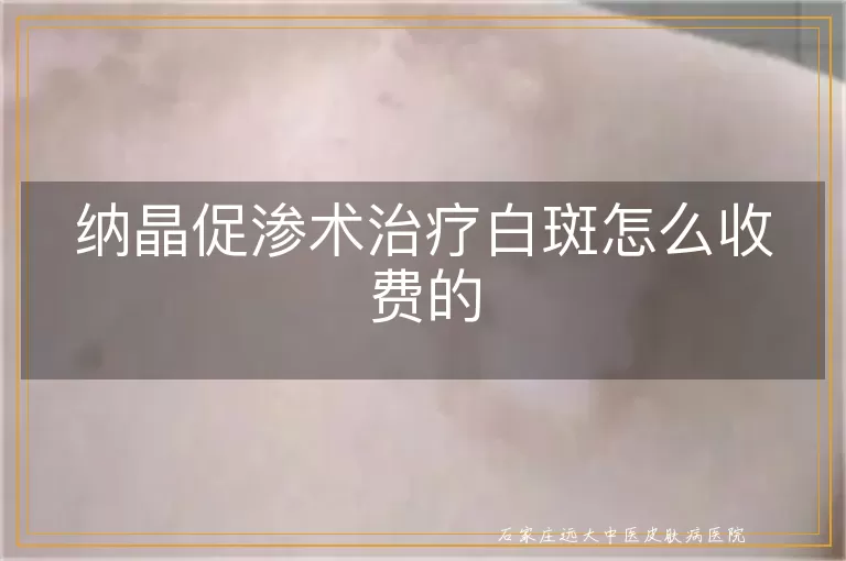 纳晶促渗术治疗白斑怎么收费的