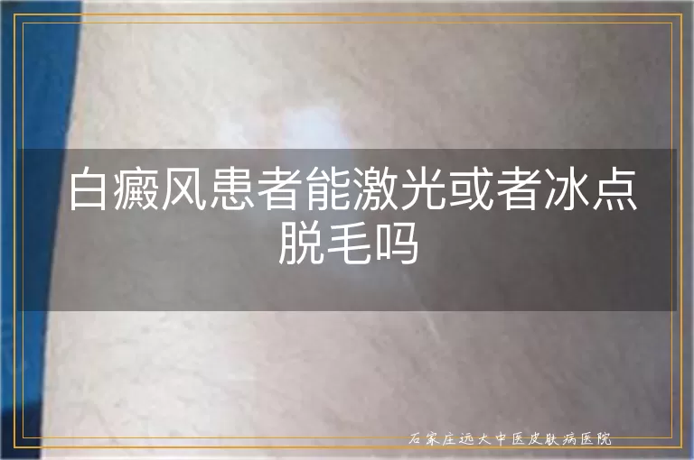 白癜风患者能激光或者冰点脱毛吗