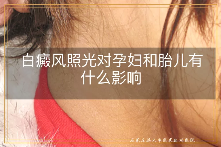 白癜风照光对孕妇和胎儿有什么影响