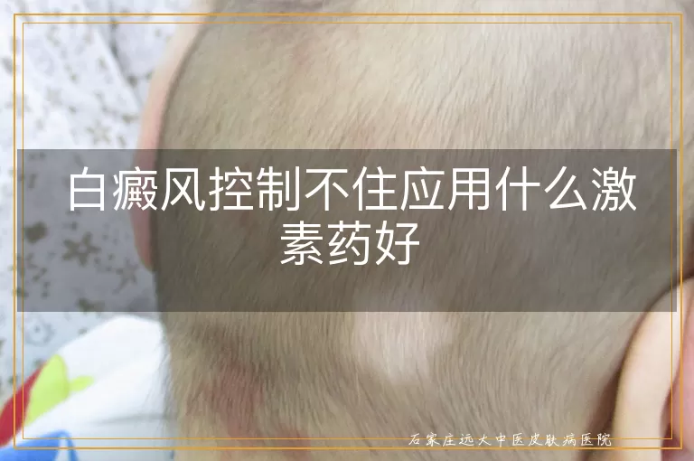 白癜风控制不住应用什么激素药好