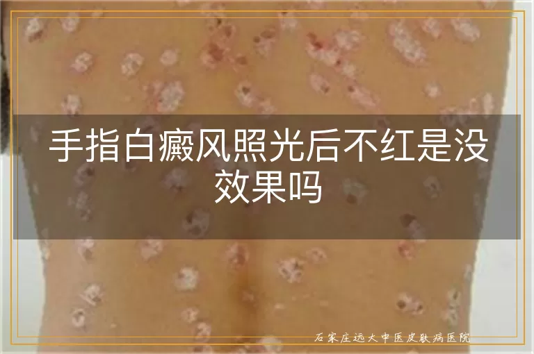 手指白癜风照光后不红是没效果吗