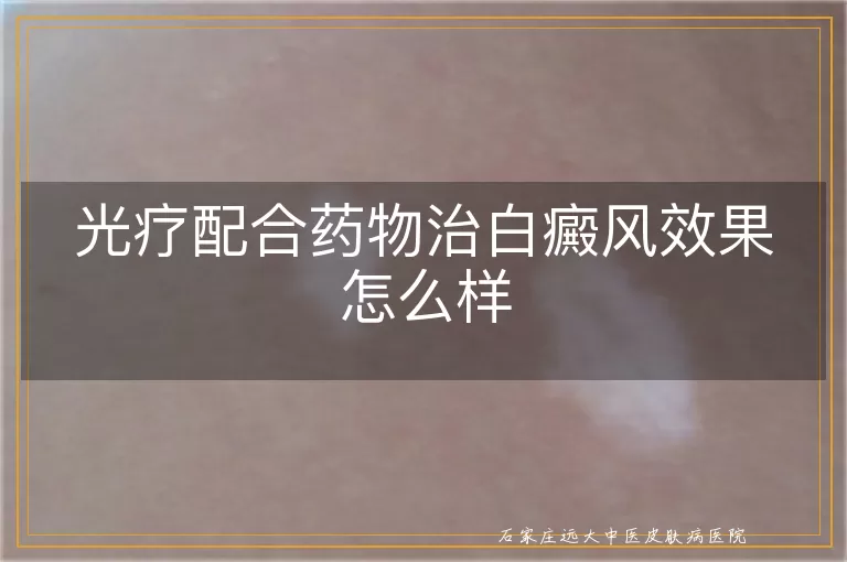 光疗配合药物治白癜风效果怎么样