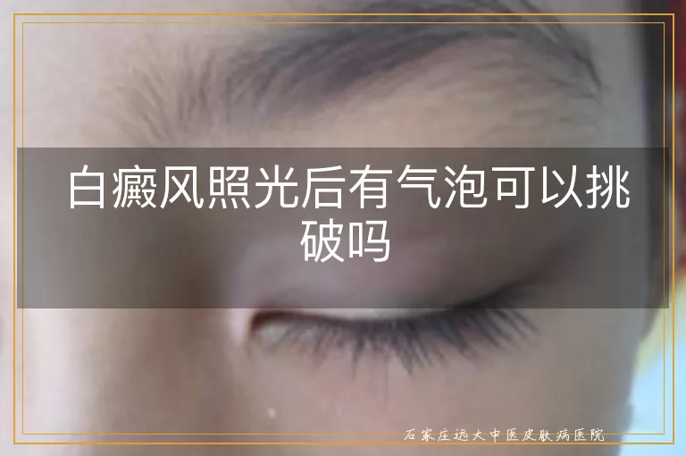 白癜风照光后有气泡可以挑破吗