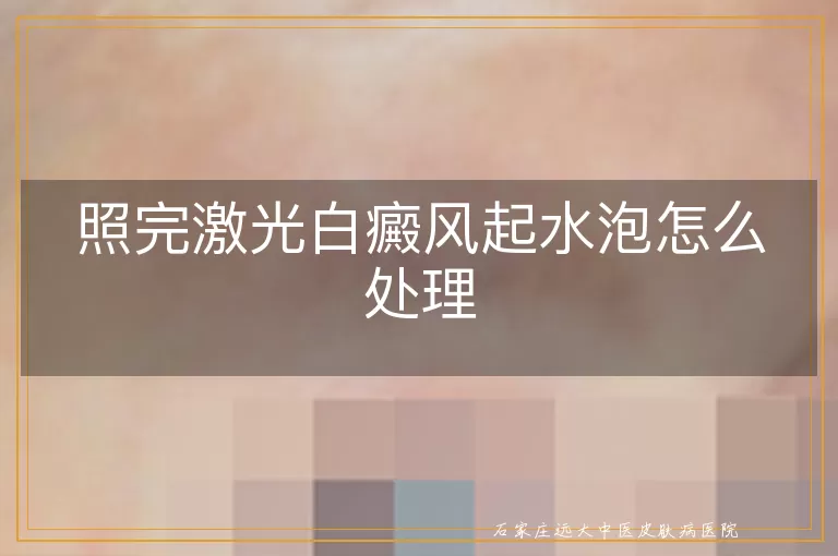照完激光白癜风起水泡怎么处理