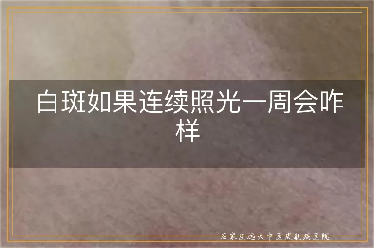 白斑如果连续照光一周会咋样