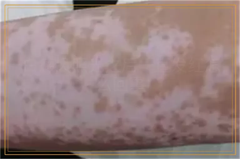 白癜风照光之后一直发红怎么回事