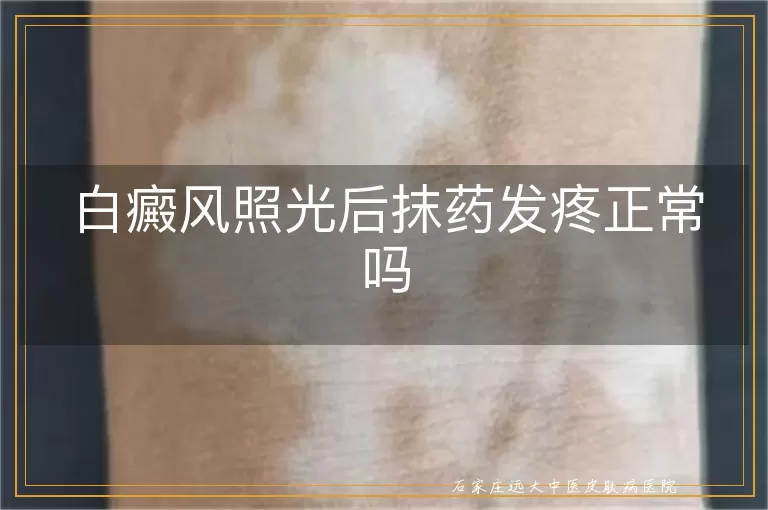 白癜风照光后抹药发疼正常吗
