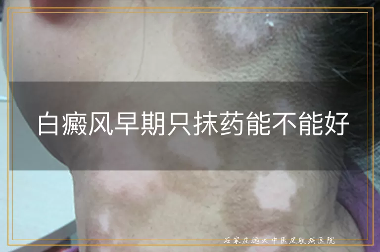 白癜风早期只抹药能不能好