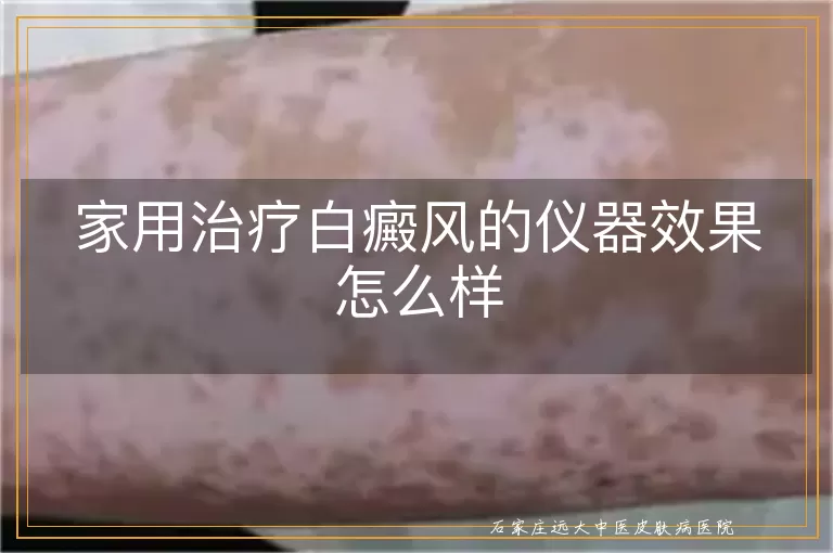 家用治疗白癜风的仪器效果怎么样