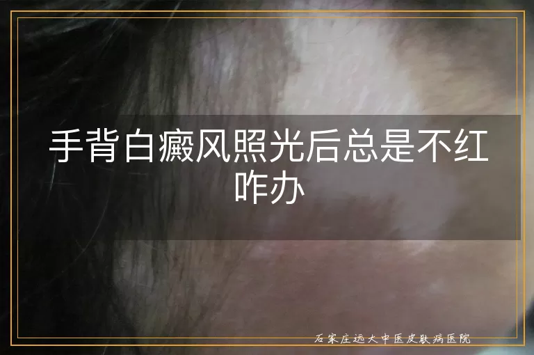 手背白癜风照光后总是不红咋办