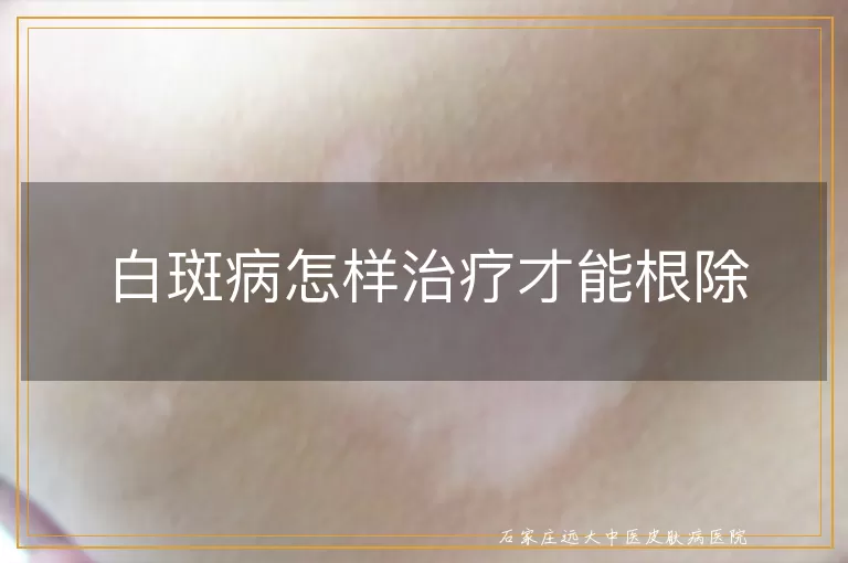白斑病怎样治疗才能根除