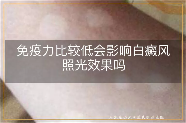 免疫力比较低会影响白癜风照光效果吗