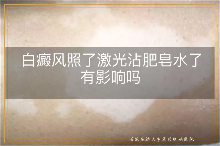 白癜风照了激光沾肥皂水了有影响吗