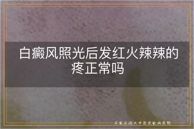 白癜风照光后发红火辣辣的疼正常吗