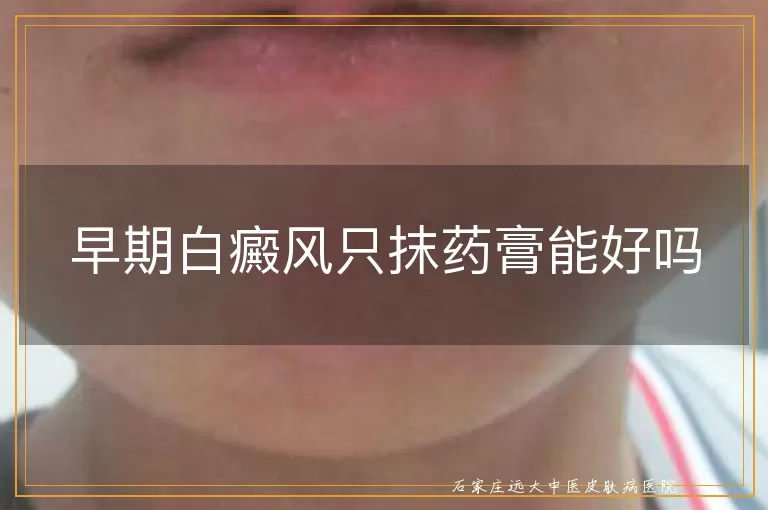 早期白癜风只抹药膏能好吗